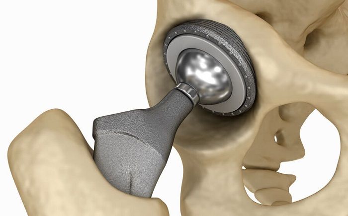 протезирование сустава 